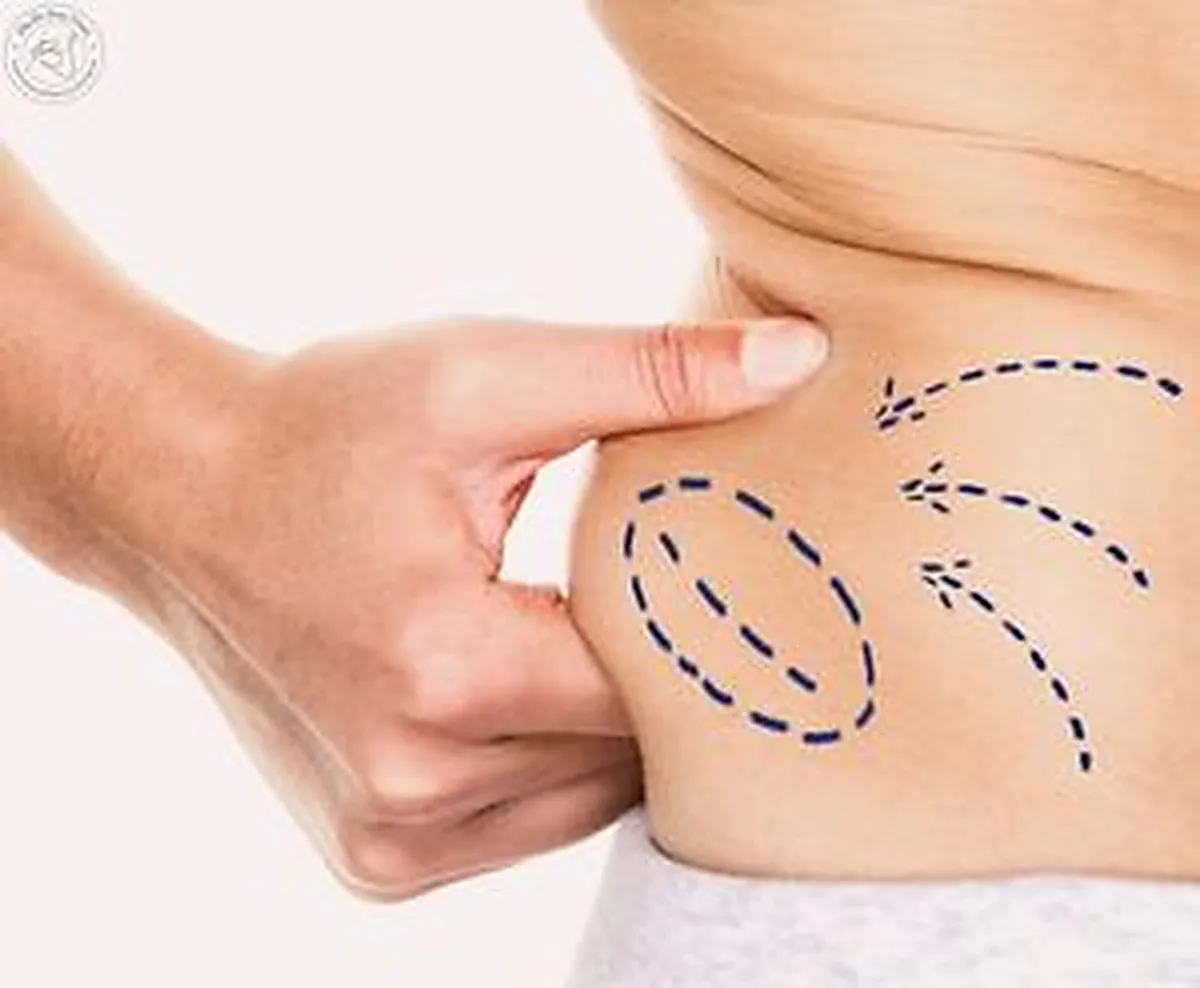 Before and after photos of liposuction by Dr. Bora Yücel